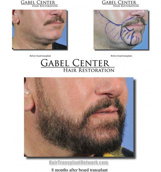 Facial hair transplants for Muslim men are on the rise in Turkey, Saudia Arabia and the UAE.  A full beard is seen by some as a "God given sign of manhood" and a direct command from the Prophet Muhammad who wanted his followers to look different from non-believers (e.g. Jews, Christians, Pagans, etc.).